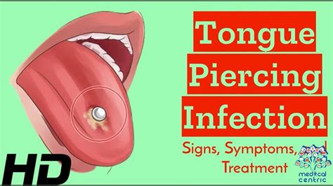 discharge from tongue piercing|How to Identify and Treat a Tongue Piercing Infection